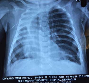 X-ray Chest